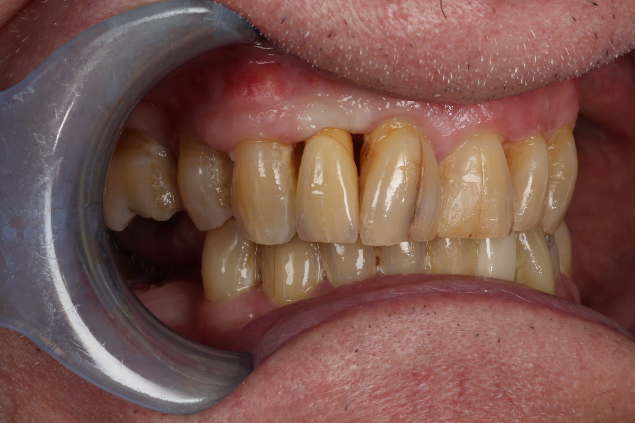 Case-7 Metal Ceramic Maryland