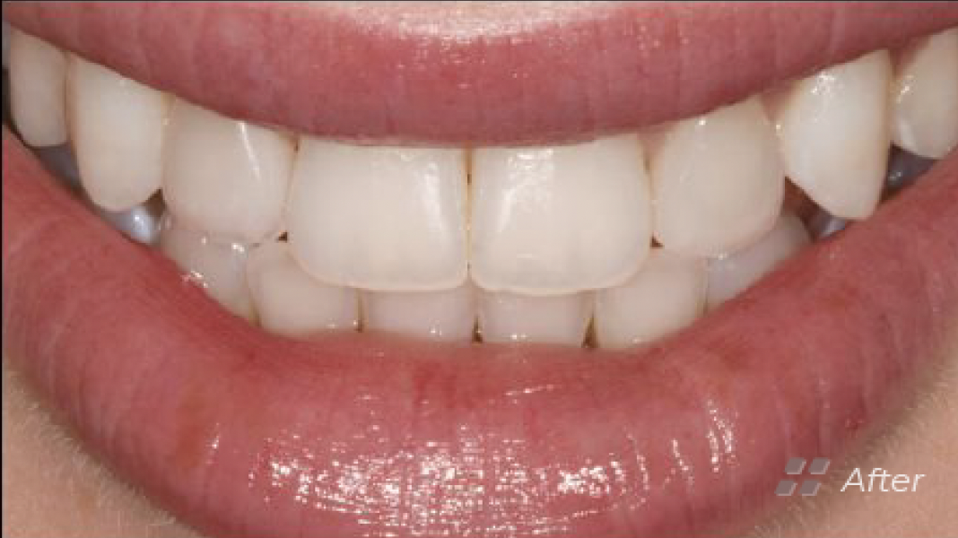 Porcelain Veneers