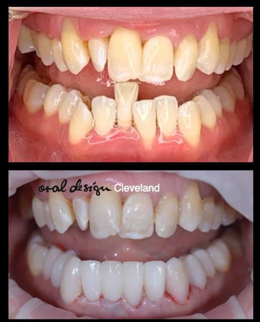 Perio case, Max will be All on 4/5 Implant Hybrid. Today prep lowers, extracted lower incisors and Provisionals to optimize occl plane to allow us to fabricate upper implant conversion to optimized lower occl plane. Next step implant placement then during