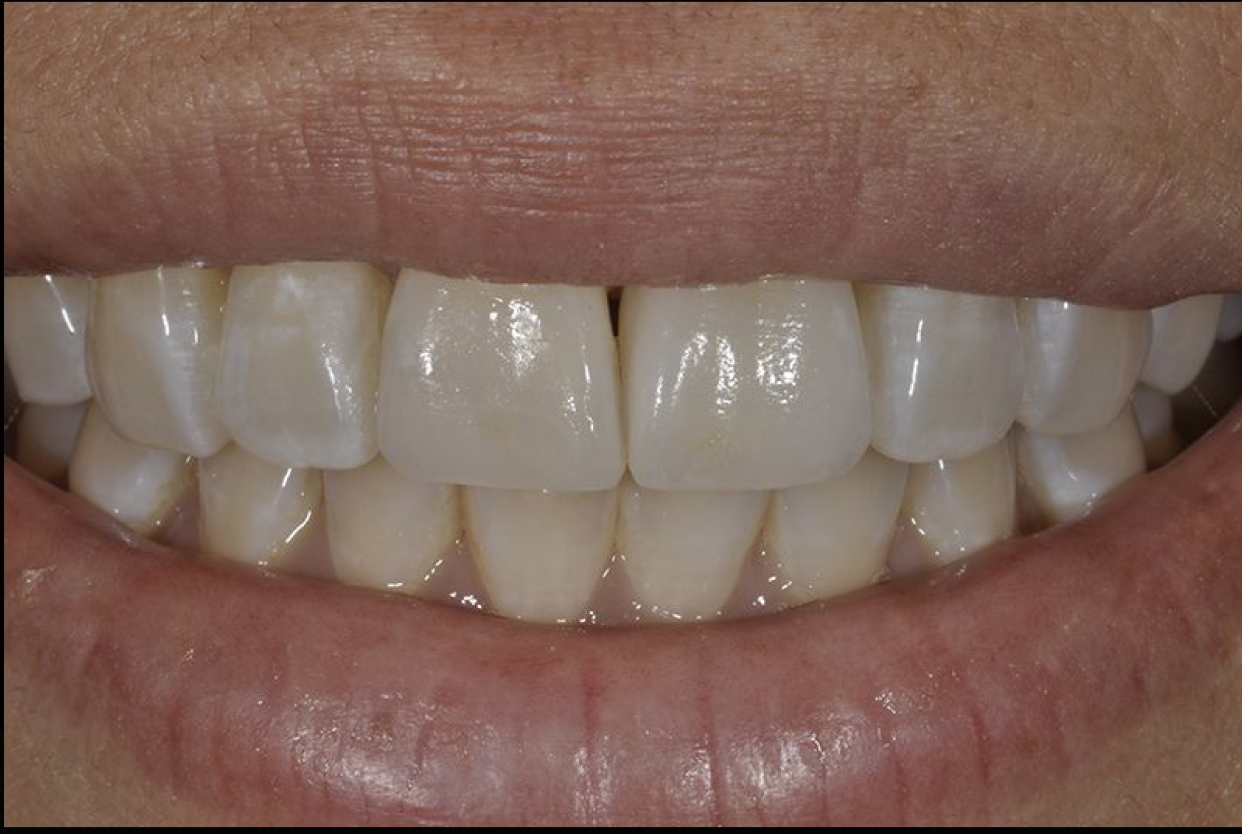 Restoration Combination: Post Veneer and Crown