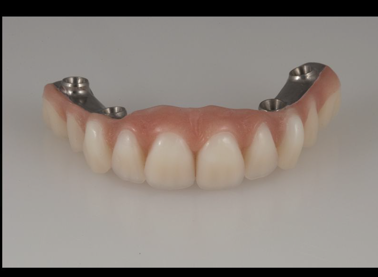 Hybrid Fixed Denture