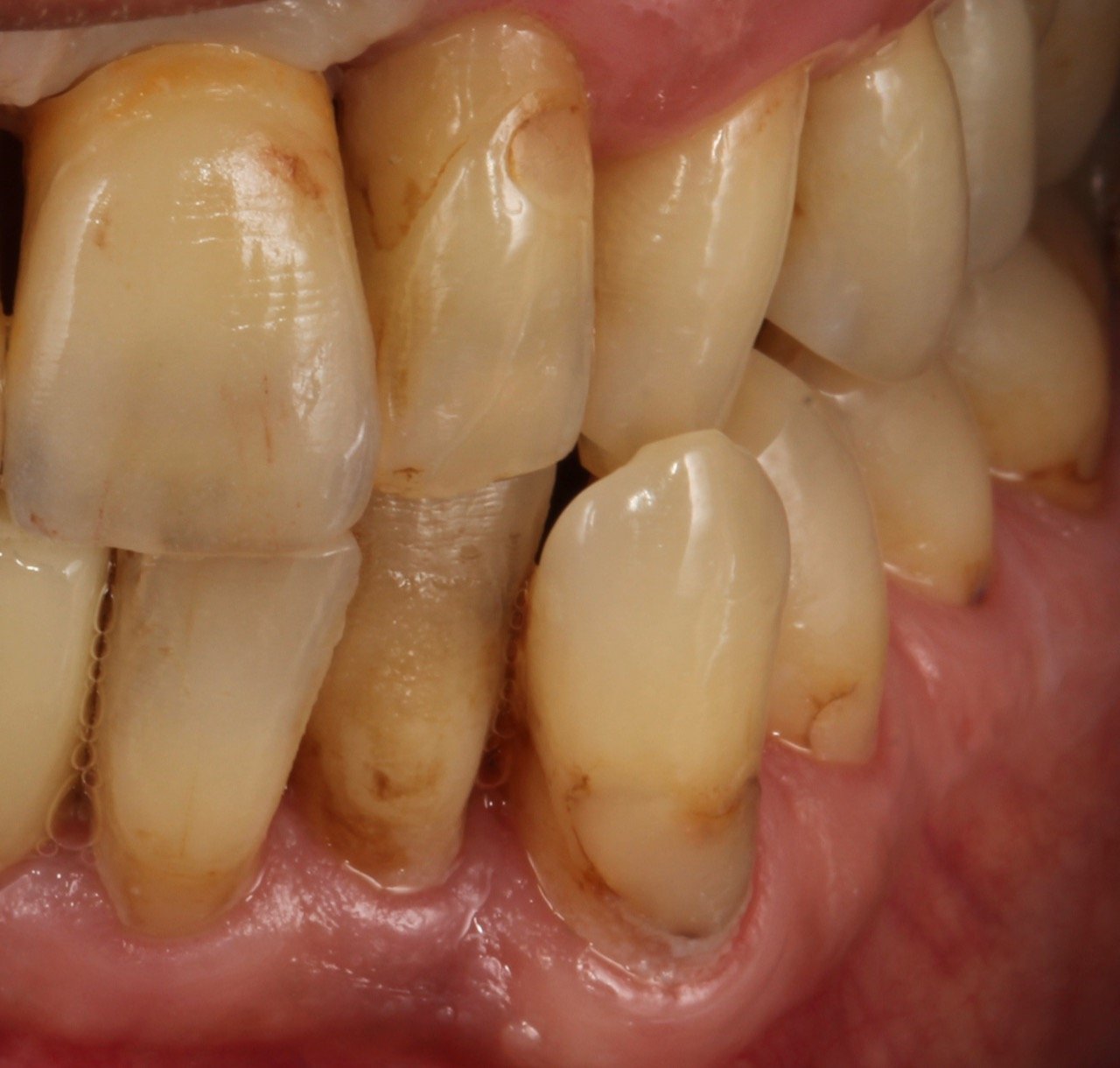 Case-5 After (Single implant)