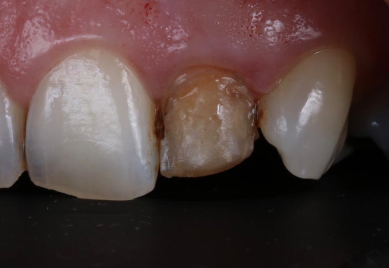 Case-4 e.max veneer