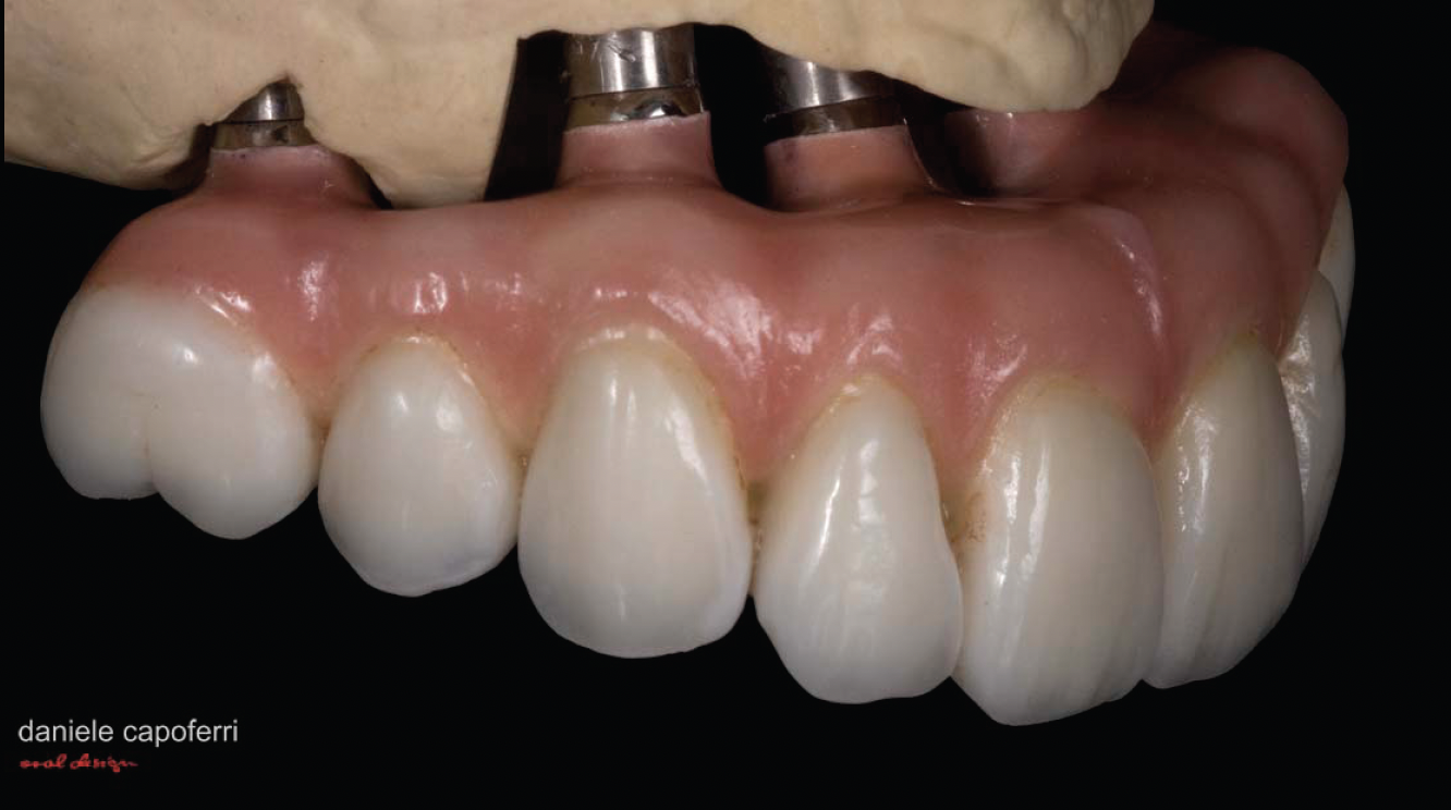 Full Mouth Restoration