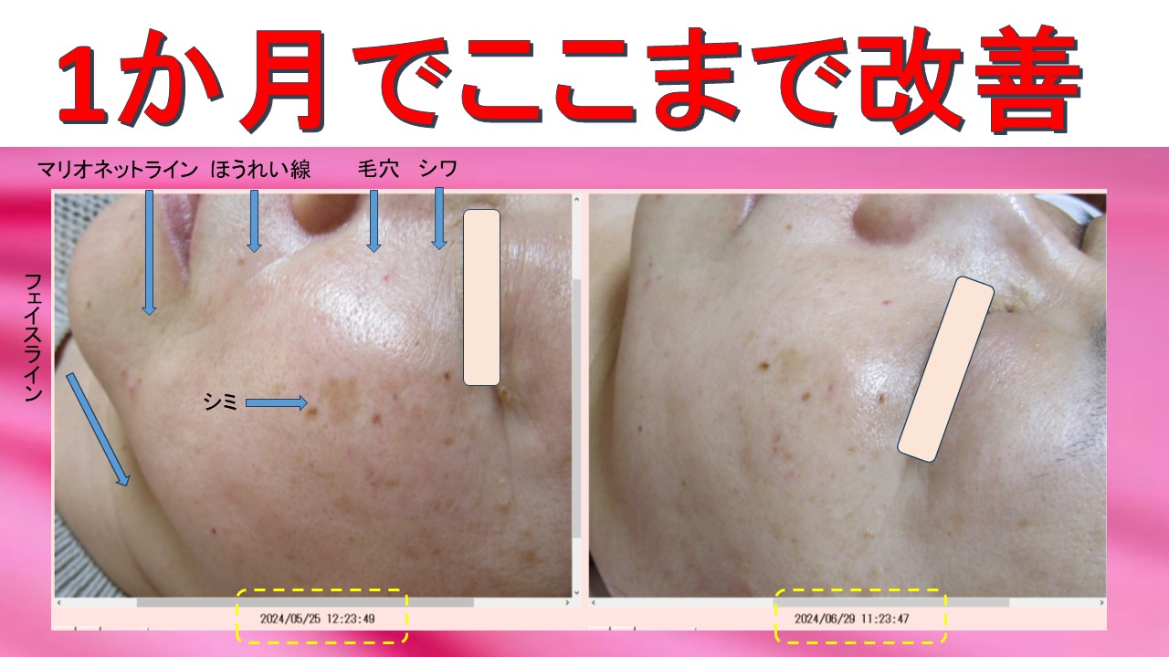 1か月でほうれい線・シミ・シワ・毛穴・マリオネットライン・フェイスライン改善