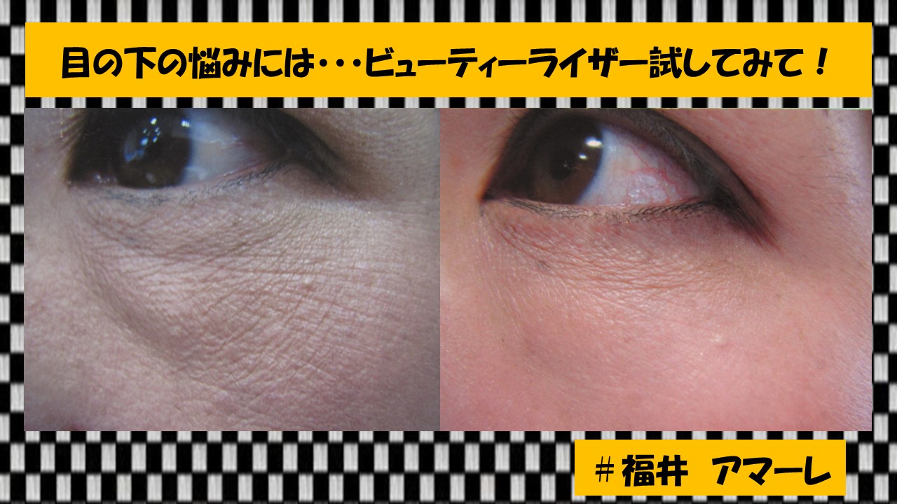 目の下の悩みには、ビューティーライザー　試してみて
