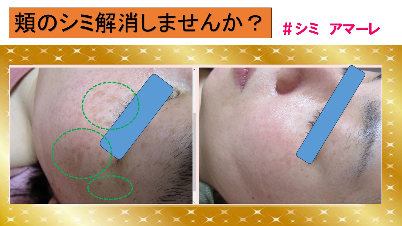 コンシーラに頼らないお肌を目指しませんか