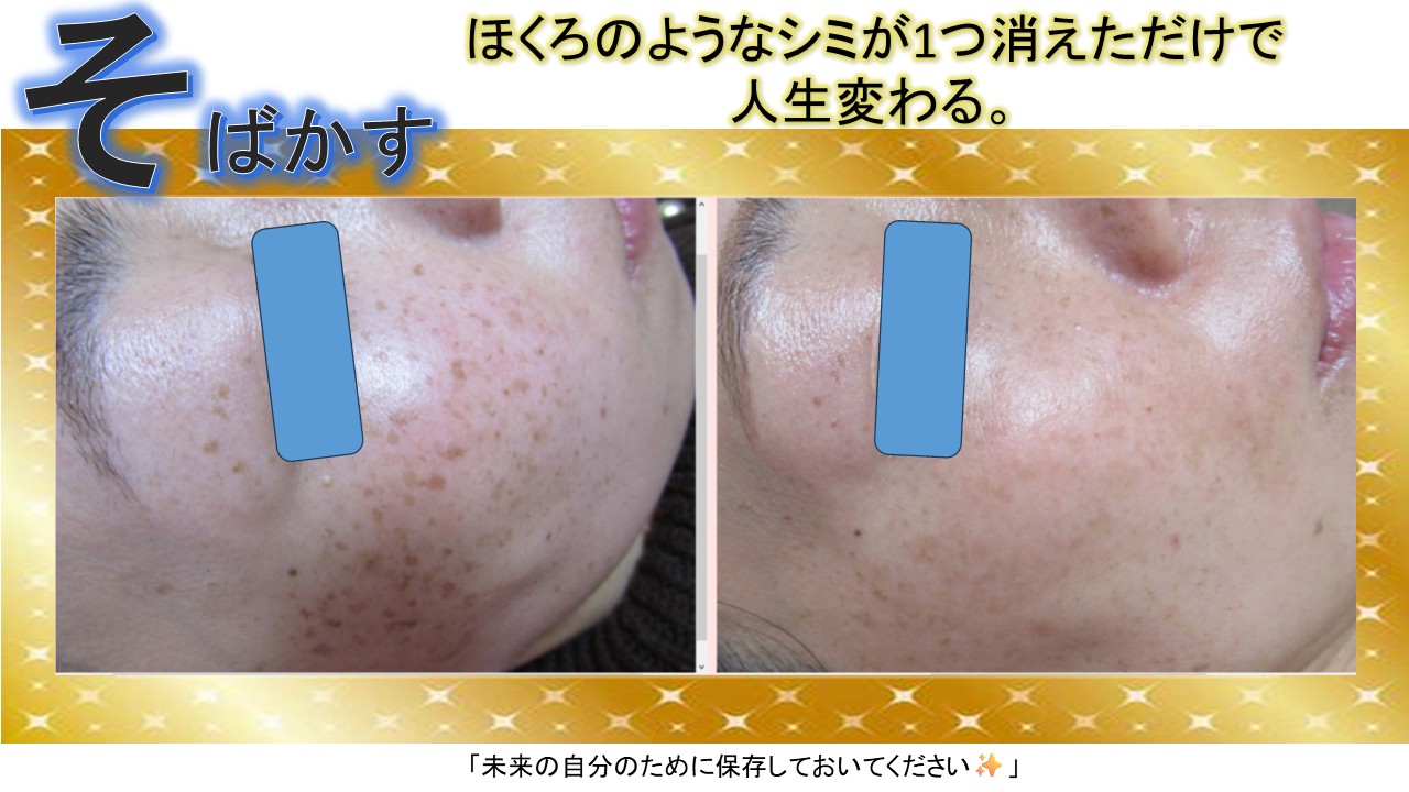 そばかす●ほくろのようなシミが1つ消えただけで、人生が変わる