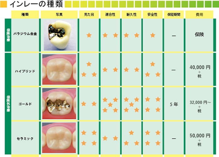 インレーの種類