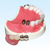 自分の歯が少なくなった人に最適のコーヌス