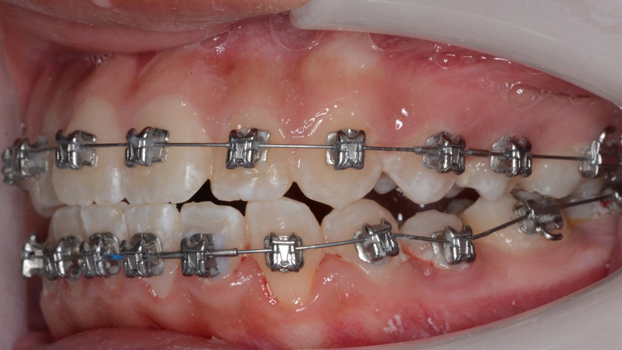 「ブラケットの位置に違和感？」を感じたことはありませんか？