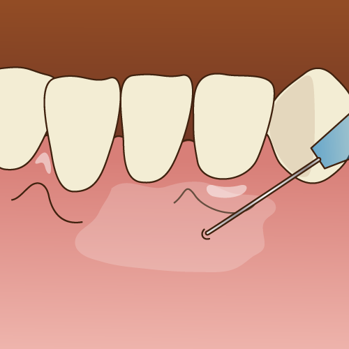 麻酔で「気持ち悪い」、「効きにくい」がなくなる方法