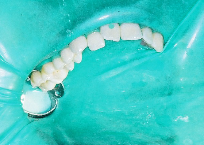 感染から歯を守るラバーダム防湿（10本法）