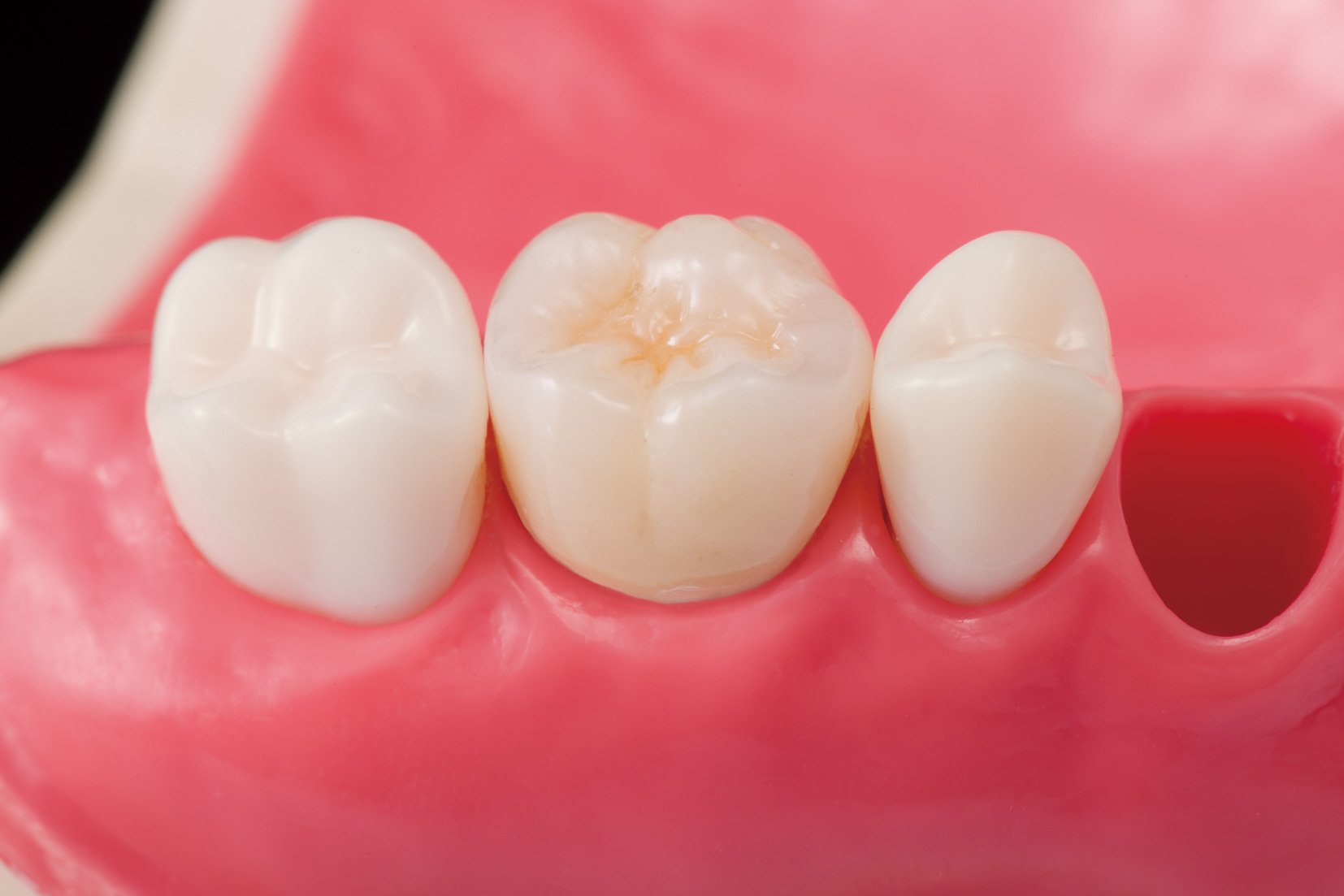 オールセラミックス