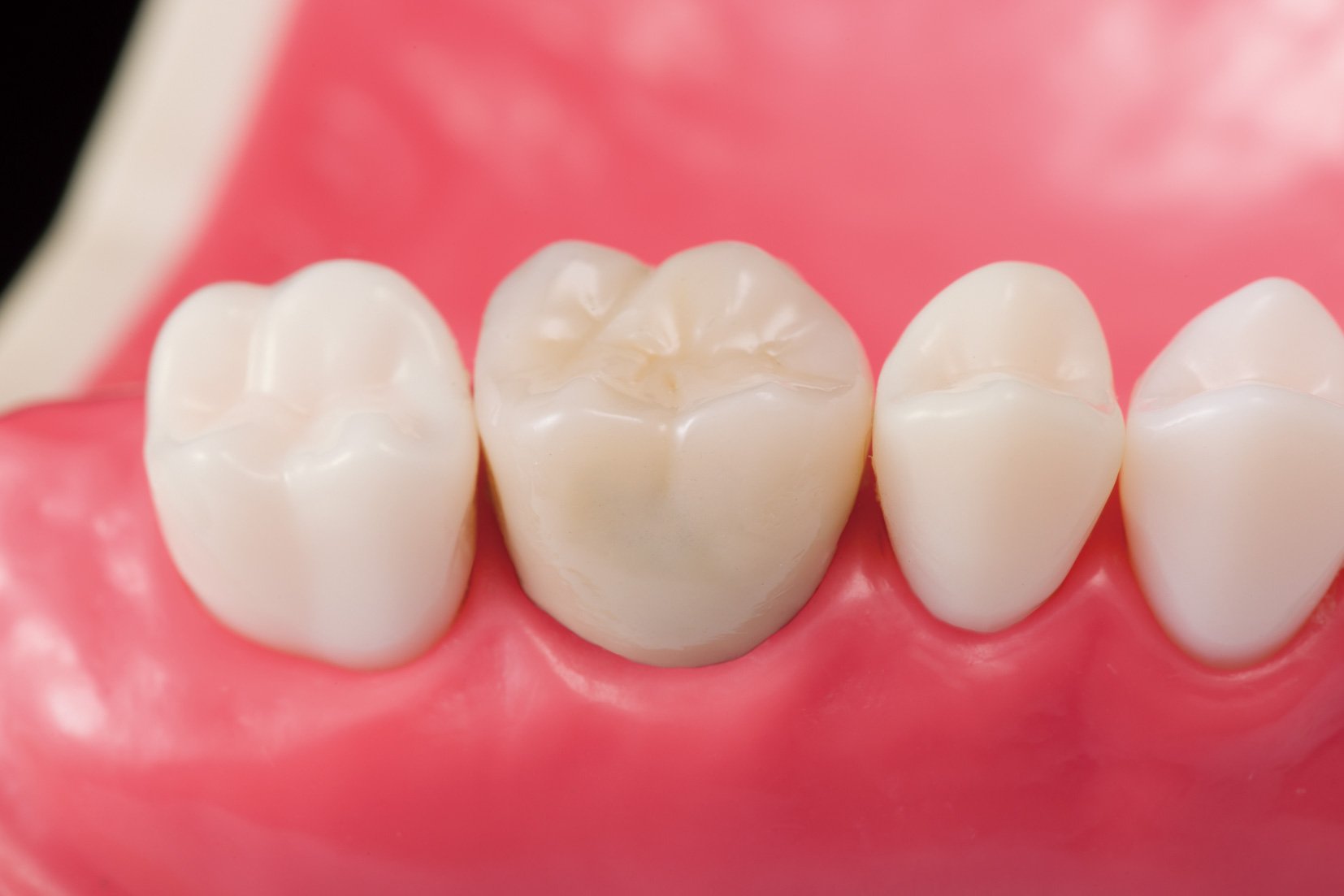 メタルセラミックス