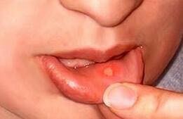 口内炎 永井歯科医院 茨木市