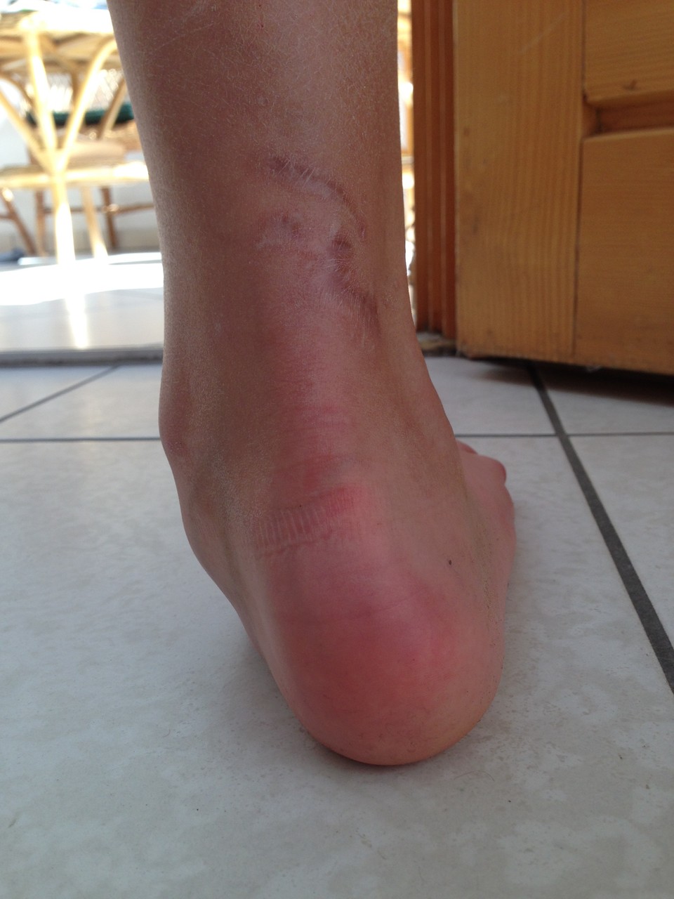 neurogener Knick-Plattfuß