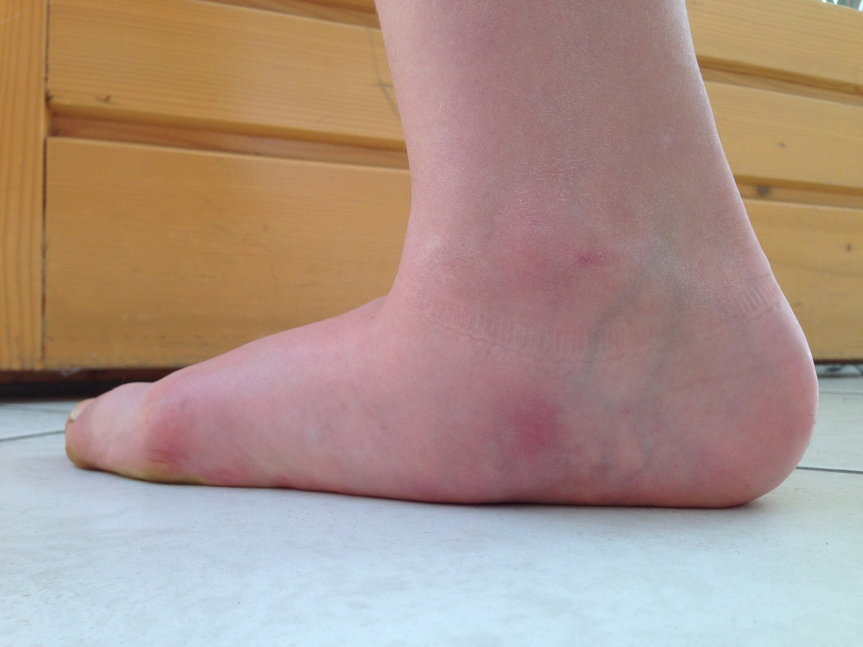 neurogener Knick-Plattfuß