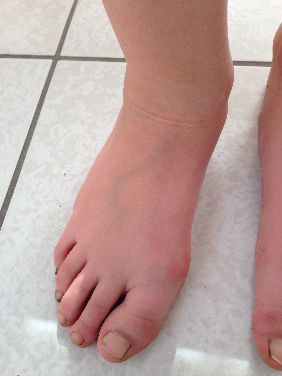 neurogener Knick-Plattfuß