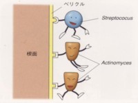 善玉菌と歯周病金が手をつないでバイオフィルムを形成