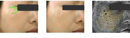 VISIA(TM) Evolutionを用いたシワ本数評価