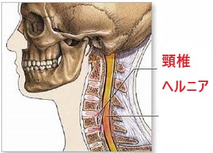 ドクターバンカイロプラクティック：頸椎ヘルニア
