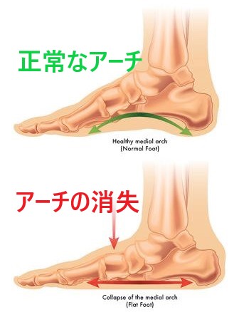 ドクターバンカイロプラクティック：Dr.Ban Chiropractic in Osaka：偏平足