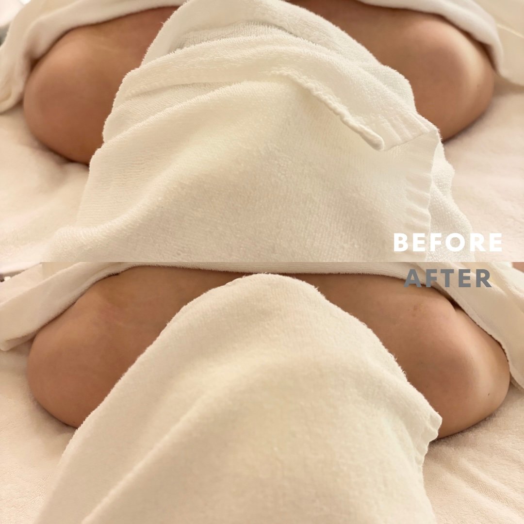 巻き肩リンパマッサージモニター④様