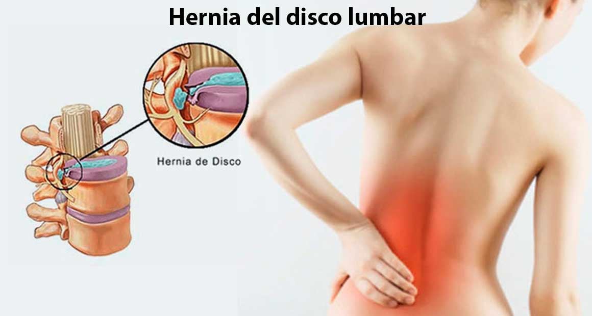 CIRUGÍA vs FISIOTERAPIA EN HERNIAS DISCALES. Decidiendo La Opción Correcta