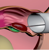 Rafaelo therapy proctology berlin