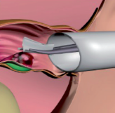 Rafaelo, geschrumpfte Hämorrhoide - Proktologie Berlin