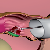 Rafaelo, Erhitzung der Hämorrhoide - Proktologie Berlin