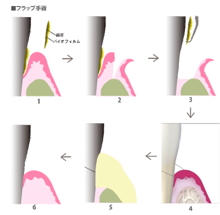 歯周外科治療(進行した歯周炎)