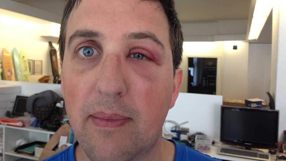 Immer wieder ist das Imkern recht schmerzhaft.