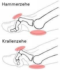 Hammerzehe und Krallenzehe
