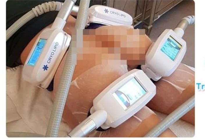 Criolipolisi di ultima generazione con 4 manipoli a raffreddamento uniforme