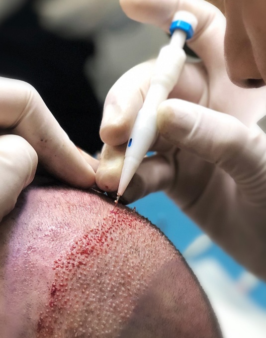 Trapianto capelli FUE-DHI