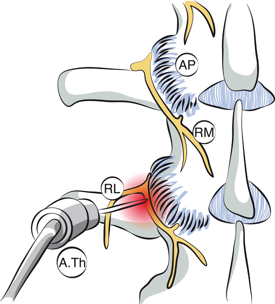 Thermocoagulation des facettes articulaires