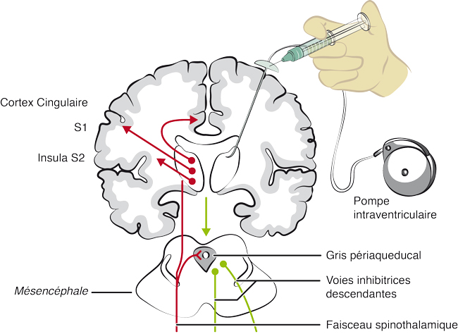 Infusion intra-ventriculaire