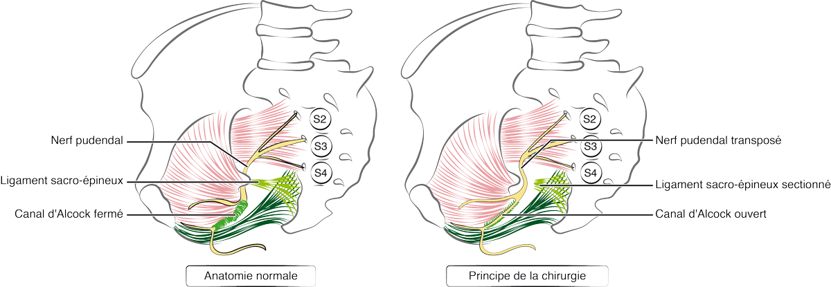 Chirurgie de la névralgie pudendale