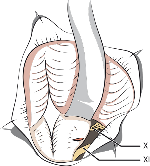 Incision bulbaire dans la tractotomie de Sjöquist