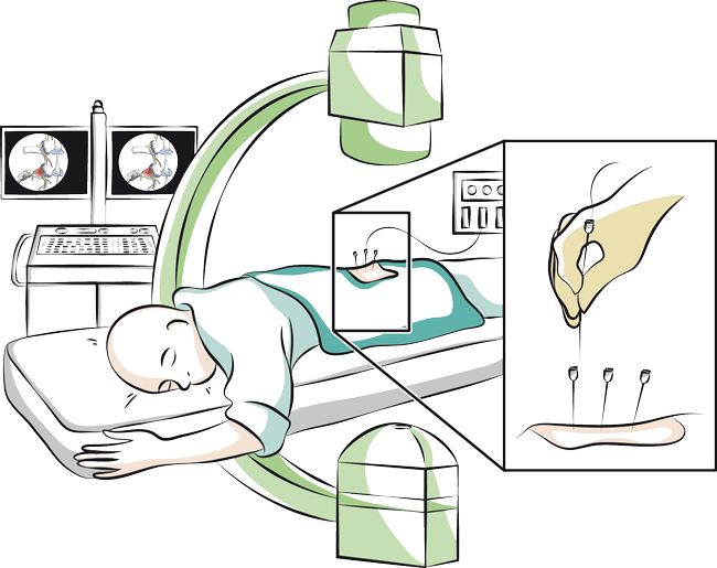 Thermocoagulation des facettes articulaires