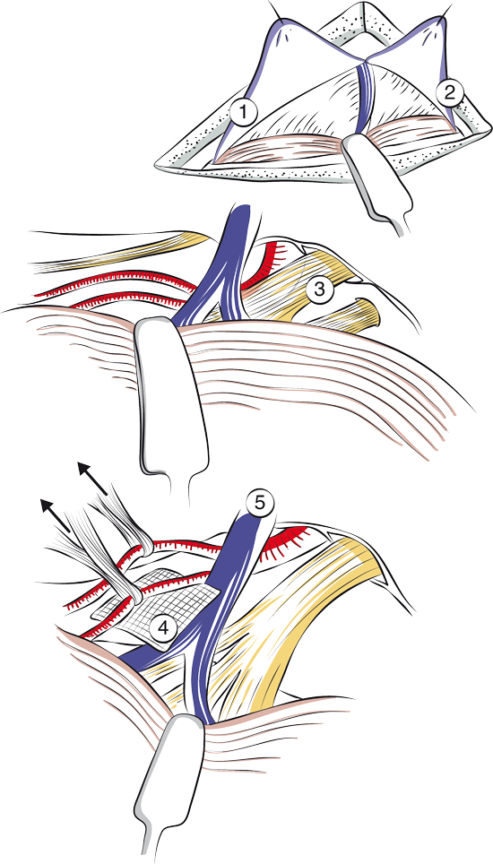 Débouclage vasculo-nerveux dans la névralgie faciale