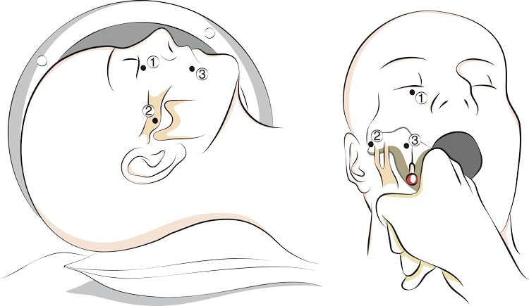 Thermocoagulation du ganglion de Gasser