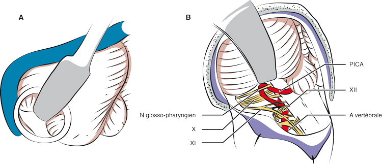 Débouclage vasculo-nerveux dans la névralgie faciale