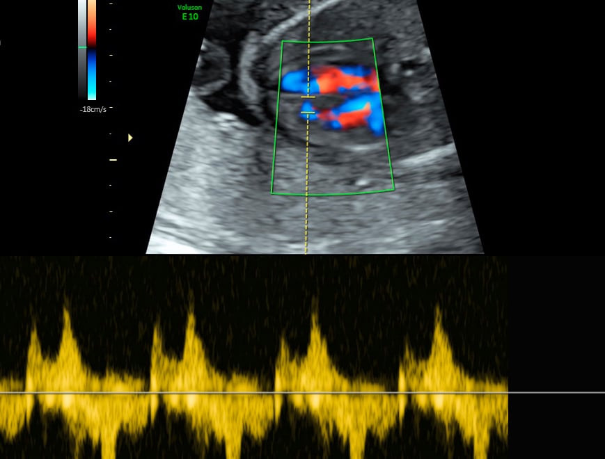 Schwangere für Ultraschallsymposium gesucht!