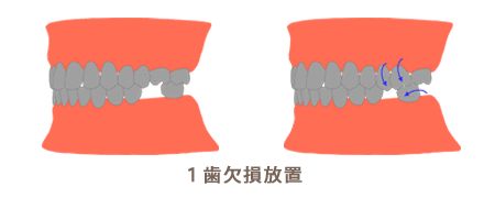 一歯欠損放置