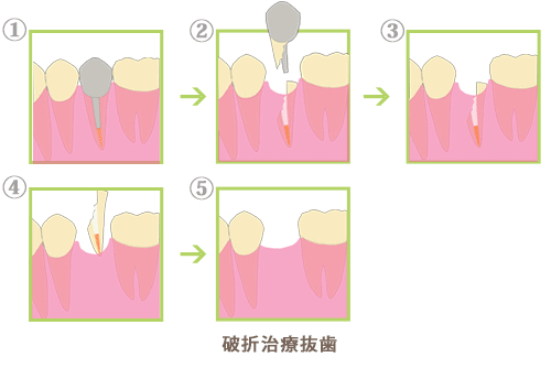 破折治療　抜歯