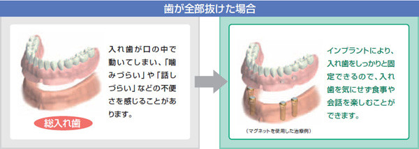 歯が全部抜けた時