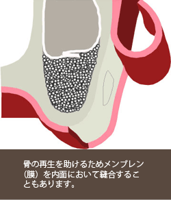 サイナスリフト４